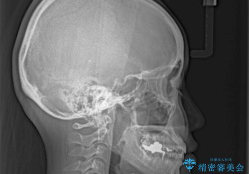 前歯のデコボコをすっきりと インビザライン矯正の治療後