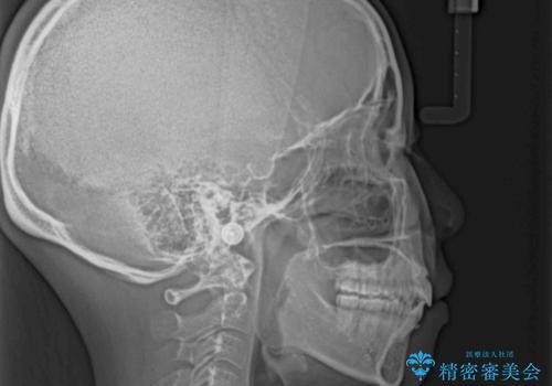 横顔の印象が大きく変わる　ワイヤー装置での抜歯矯正の治療後