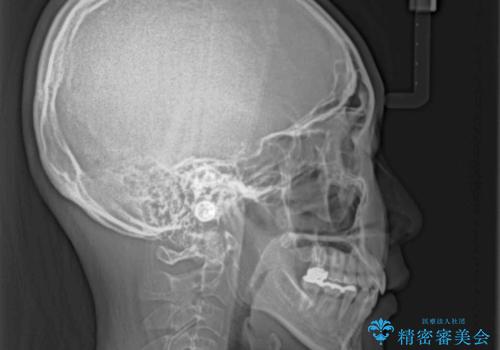 口が閉じにくい ワイヤー装置での抜歯矯正の治療後