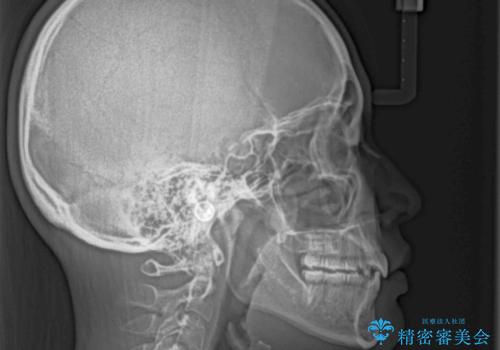 ワイヤー装置の抜歯矯正で横顔のシルエットをすっきりとの治療後