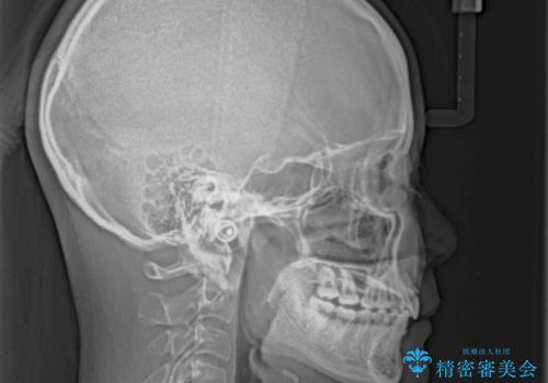 飛び出した前歯をインビザラインですっきりとの治療後