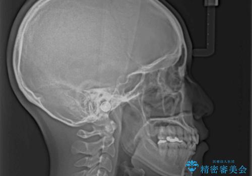 急速拡大とワイヤー抜歯矯正で唇を閉じやすくの治療後