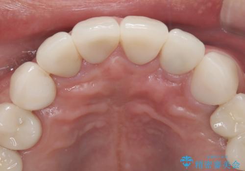 【オールセラミッククラウン・ファイバーコア】被せ物が揺れているの治療後