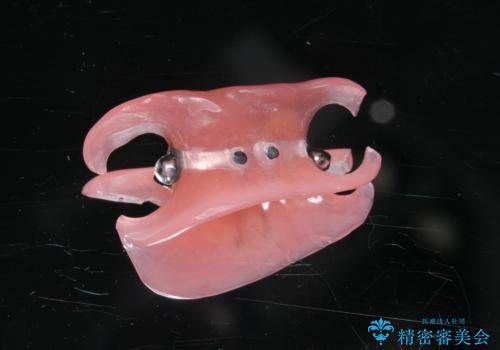 ノンクラスプデンチャーの治療後