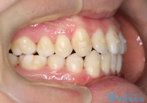 笑顔が魅力的に変わる! インビザライン矯正で前歯のすきっぱを改善しましたの治療中