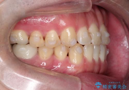 マウスピース矯正で自然な笑顔を実現! 前歯の咬み合わせを治しました。の治療中
