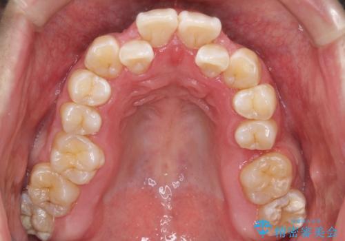 マウスピース矯正で素敵な笑顔に変身!前歯のガタツキを治しましたの治療前