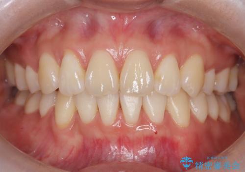 裏側矯正でEラインを改善! すっきりした口元に!の症例 治療後