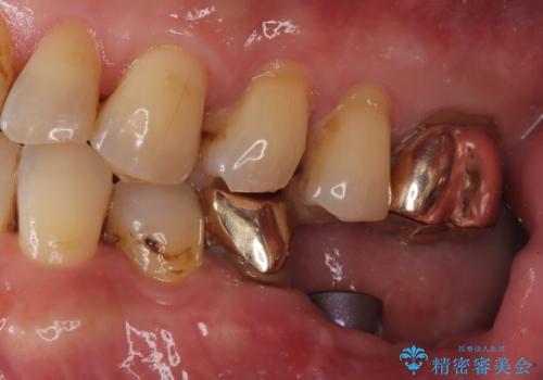 【ゴールドインレー PGA】フロスをしたら銀歯が取れたの治療前