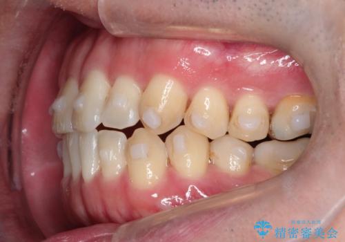 マウスピース矯正で自然な笑顔を実現! 前歯の咬み合わせを治しました。の治療中