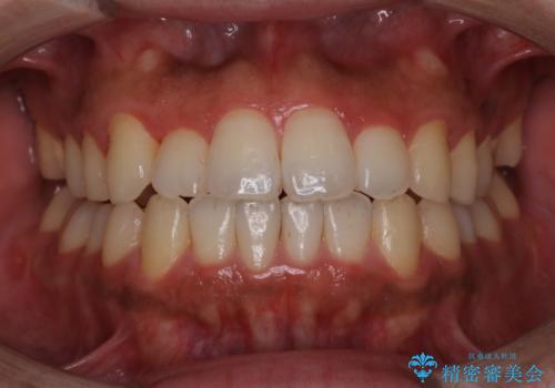 1年ぶりのオフィスホワイトニングの治療前