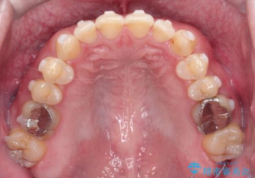 マウスピース矯正で自然な笑顔を実現! 前歯の咬み合わせを治しました。の治療中