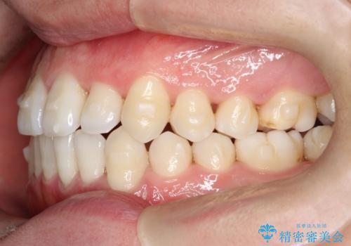 笑顔が魅力的に変わる! インビザライン矯正で前歯のすきっぱを改善しましたの治療中