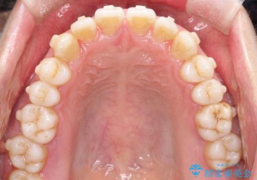 笑顔が魅力的に変わる! インビザライン矯正で前歯のすきっぱを改善しましたの治療中