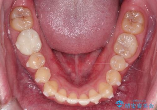 マウスピース矯正で自然な笑顔を実現! 前歯の咬み合わせを治しました。の治療中