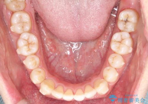 笑顔が魅力的に変わる! インビザライン矯正で前歯のすきっぱを改善しましたの治療中