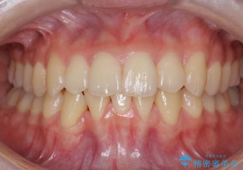 他3軒で4本抜いてワイヤー矯正と言われた 1本の抜歯でマウスピース矯正で治療可能ですの治療後