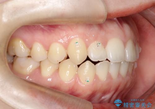 前歯のガタツキ、前歯の噛み合わせ(開咬)をインビザライン治療で治しましたの治療中