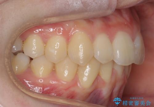他3軒で4本抜いてワイヤー矯正と言われた 1本の抜歯でマウスピース矯正で治療可能ですの治療後