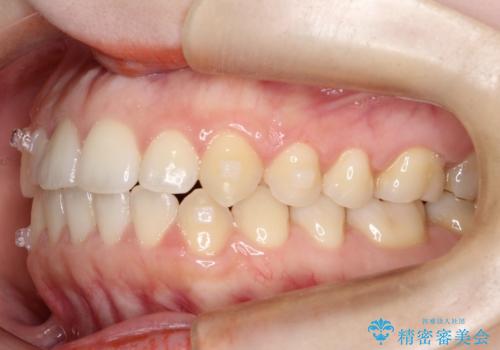 前歯のガタツキ、前歯の噛み合わせ(開咬)をインビザライン治療で治しましたの治療中