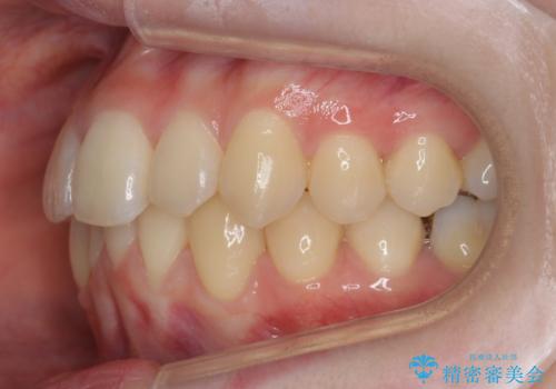 他3軒で4本抜いてワイヤー矯正と言われた 1本の抜歯でマウスピース矯正で治療可能ですの治療後