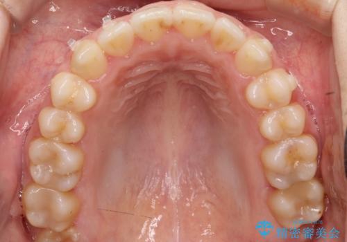 前歯のガタツキ、前歯の噛み合わせ(開咬)をインビザライン治療で治しましたの治療中