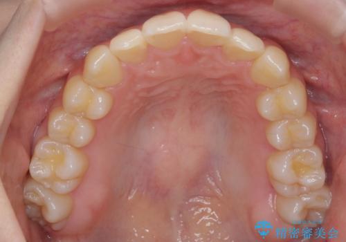 他3軒で4本抜いてワイヤー矯正と言われた 1本の抜歯でマウスピース矯正で治療可能ですの治療後