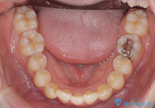 他3軒で4本抜いてワイヤー矯正と言われた 1本の抜歯でマウスピース矯正で治療可能ですの治療後