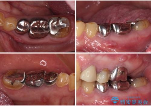 割れてしまった奥歯 インプラントによる補綴治療の治療前