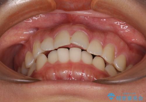 飛び出した上顎前歯 インビザラインで引っ込めるの治療前