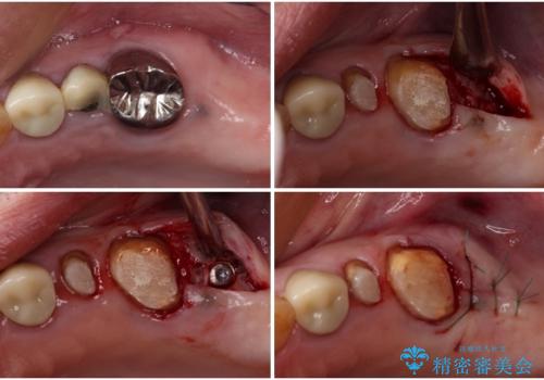 割れてしまった奥歯 インプラントによる補綴治療の治療中