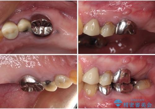 割れてしまった奥歯 インプラントによる補綴治療の治療前