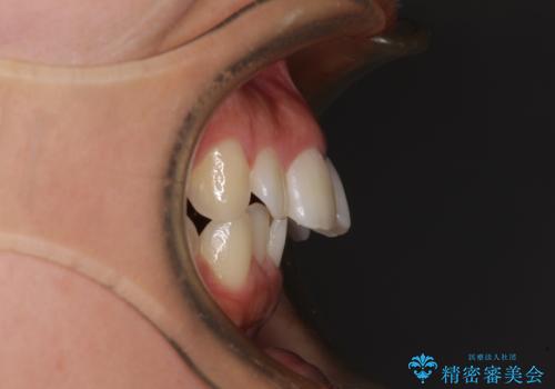 飛び出した上顎前歯 インビザラインで引っ込めるの治療前