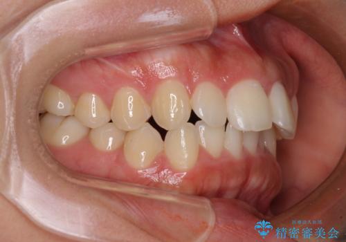 飛び出した上顎前歯 インビザラインで引っ込めるの治療前