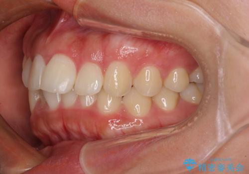 飛び出した上顎前歯 インビザラインで引っ込めるの治療前