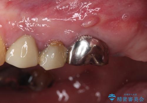 割れてしまった奥歯 インプラントによる補綴治療の治療前