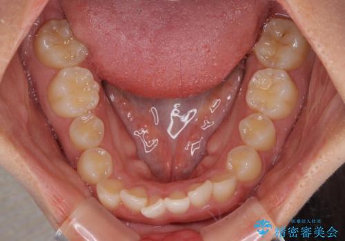 飛び出した上顎前歯 インビザラインで引っ込めるの治療前