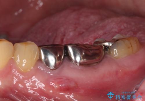 割れてしまった奥歯 インプラントによる補綴治療の治療前