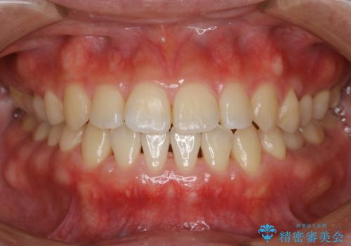 歯茎が薄い方へのインビザライン治療、歯肉退縮予防の症例 治療後