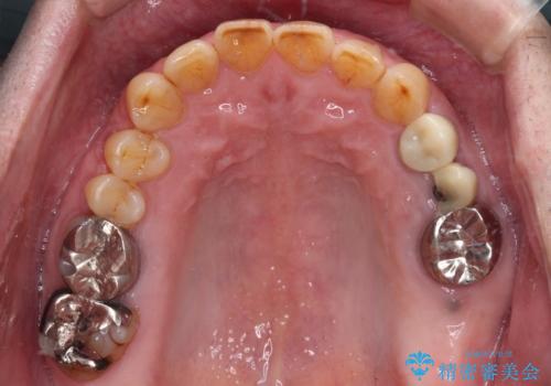 割れてしまった奥歯 インプラントによる補綴治療の治療前