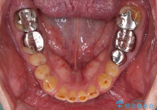 割れてしまった奥歯 インプラントによる補綴治療の治療前