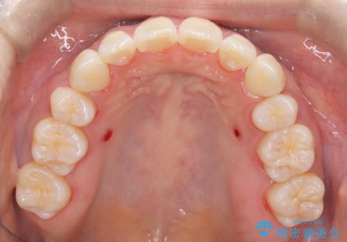 裏側矯正でEラインを改善! すっきりした口元に!の治療後