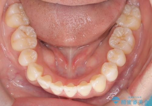 裏側矯正でEラインを改善! すっきりした口元に!の治療後