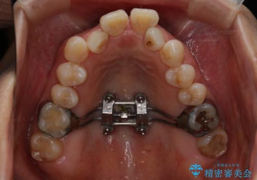 インビザライン、非抜歯でここまでできる。補助装置との組み合わせで顎のゆがみとかみ合わせを治すの治療中