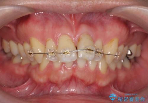 出っ歯を部分矯正で目立たなくする　セラミック治療もの治療中