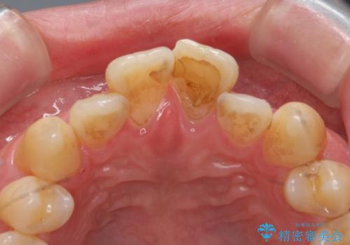 出っ歯を部分矯正で目立たなくする セラミック治療もの治療前