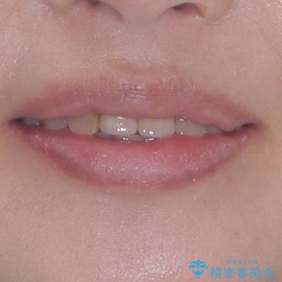 前歯のデコボコをワイヤー矯正できれいに整えるの治療後（顔貌）