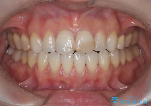 【オールセラミッククラウン】前歯の色が気になる!　左右で歯の長さが違うの治療前