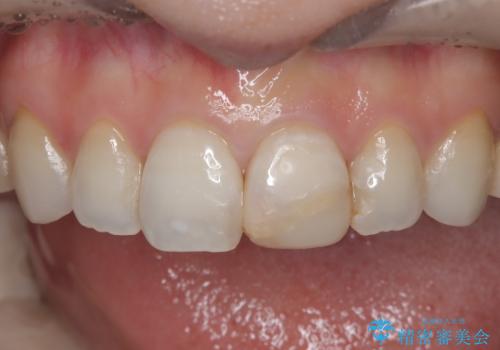 【オールセラミッククラウン】前歯の色が気になる! 左右で歯の長さが違うの治療前