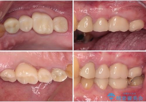 割れてしまった奥歯 インプラントによる補綴治療の治療後